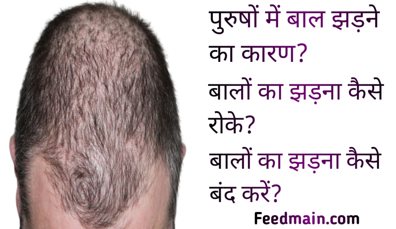 You are currently viewing पुरुषों में बाल झड़ने के कारण। बाल झड़ने के कारण। बालो का झड़ना कैसे रोके। hair fall reason in hindi.